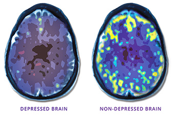 NeuroStar TMS As Alternative Depression Treatment