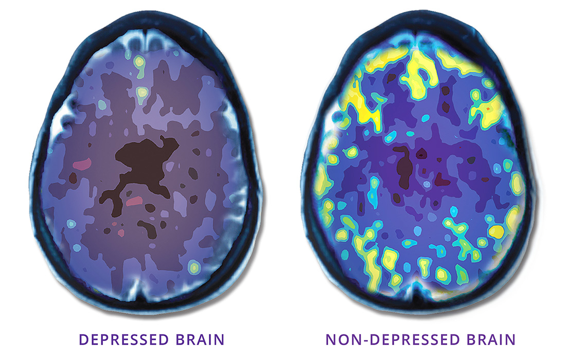 Photos of two brains: depressed and non-depressed showing benefits of NeuroStar TMS therapy